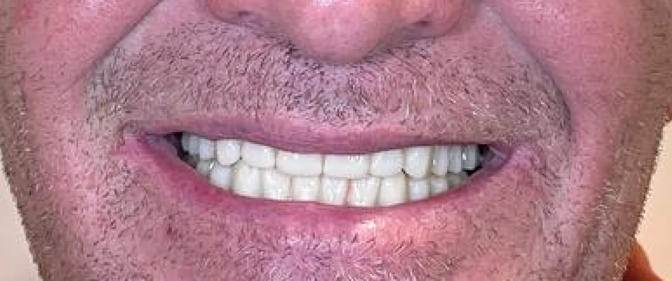 After treatment, example 1