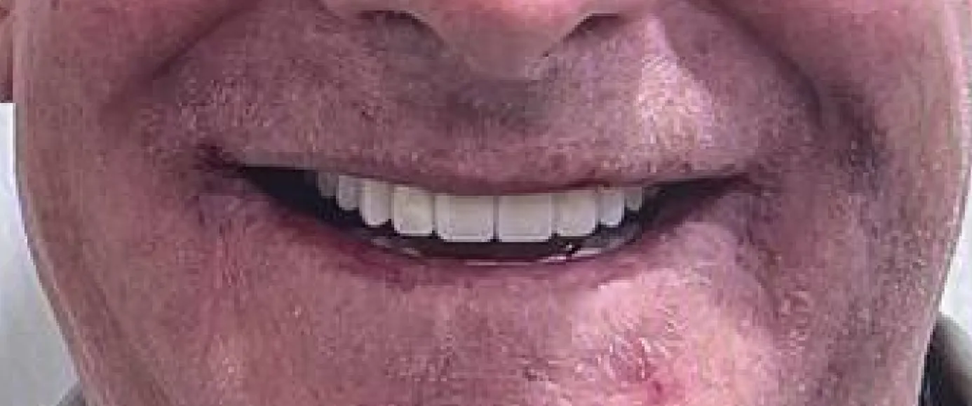After treatment, example 2