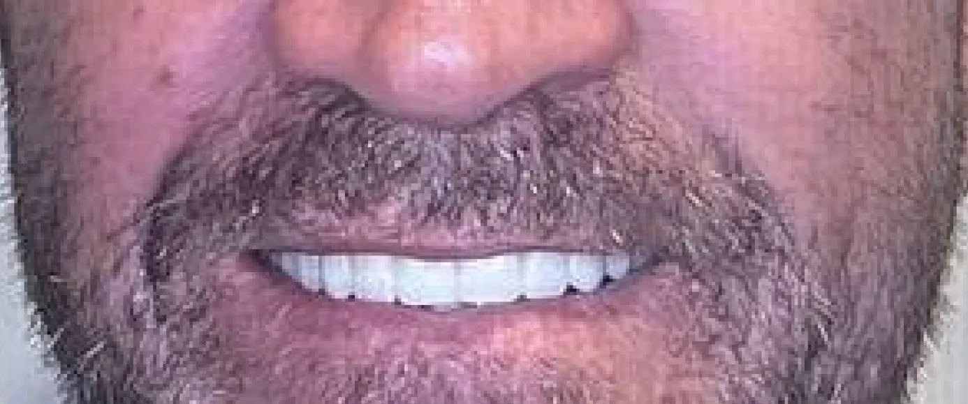 After treatment, example 3