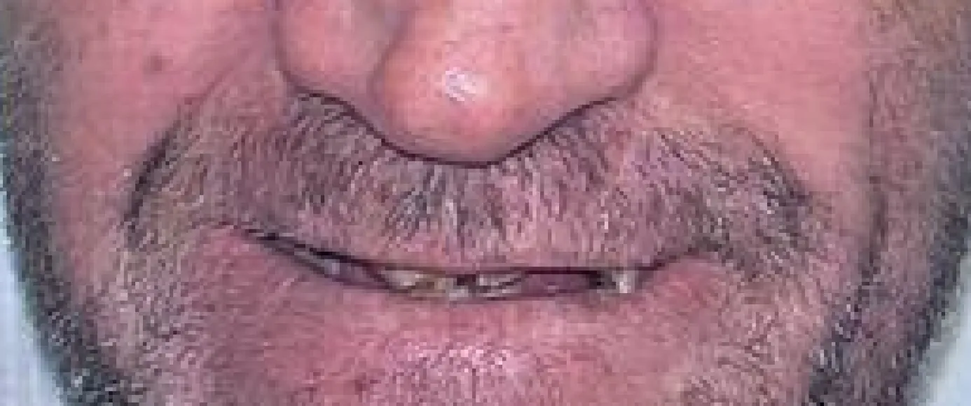 Before treatment, example 3