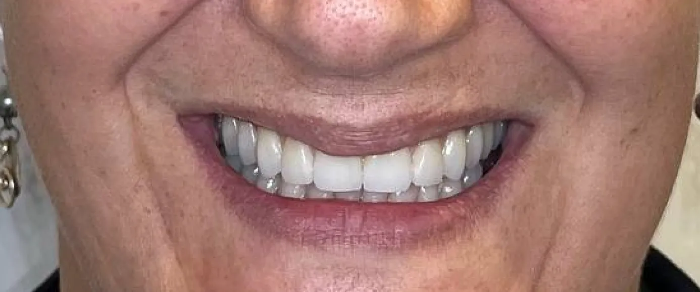 After treatment, example 4