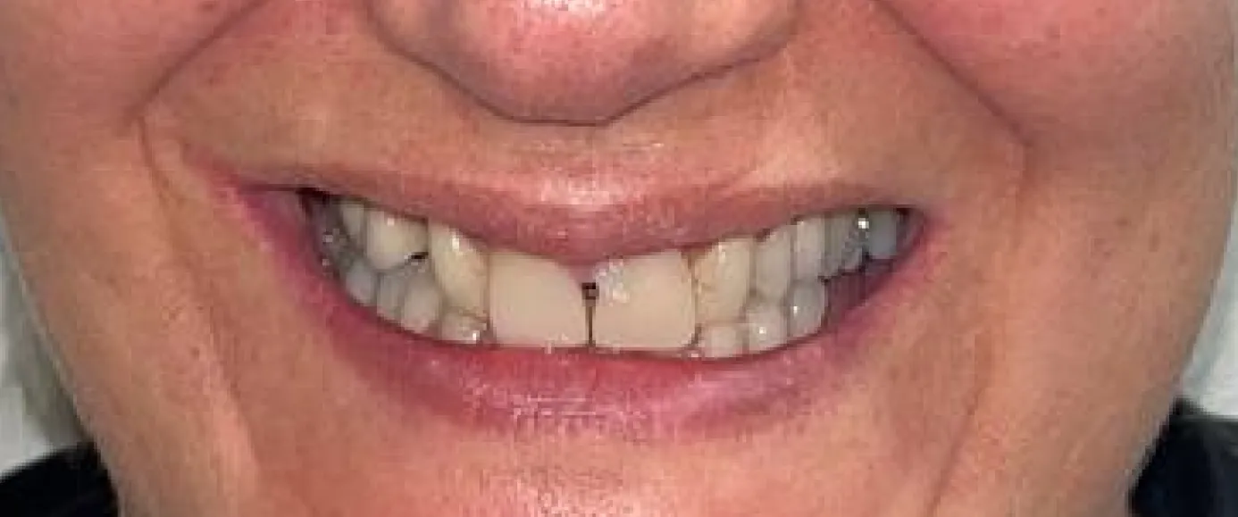 Before treatment, example 4